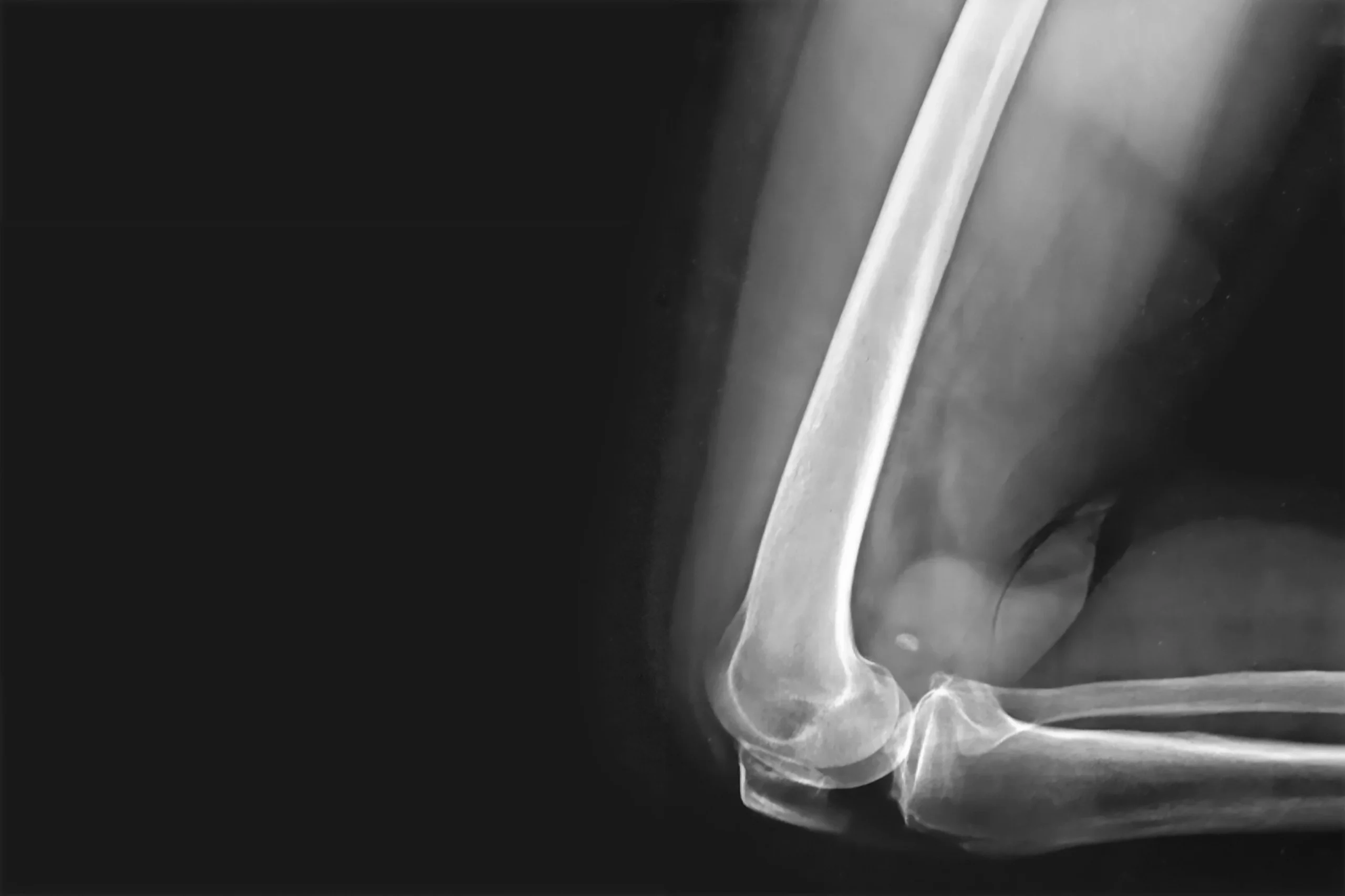 X-ray image of a bent elbow joint.